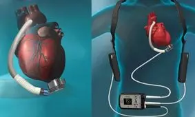 این زن آمریکایی نبض ندارد و با باتری زندگی می‌کند