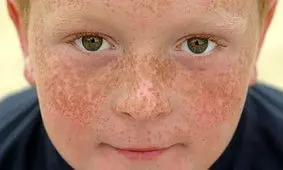 افزایش کک و مک و تعداد خال ها با قرارگیری زیاد برابر نور خورشید