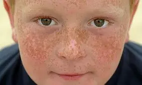افزایش کک و مک و تعداد خال ها با قرارگیری زیاد برابر نور خورشید