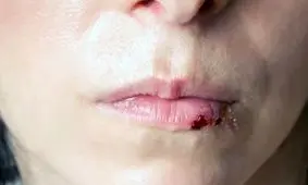 درمان موثر آسیب‌های لب‌ با کمک یک مدل سه‌بعدی

