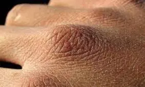 اجتناب از درمان های خانگی برای خشکی پوست