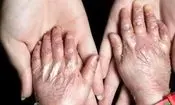 شناسایی ۴۹۲ گونه بیماری نادر و چالش‌های هزینه‌های درمانی در ایران
