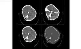 نظر متخصصین نرورادیولژی درباره تصاویر سی‌تی اسکن «مهسا امینی»