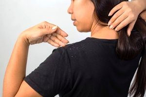 ۱۰ درمان خانگی برای رفع شوره سر