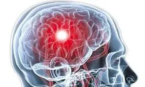 سکته مغزی در کمین مبتلایان به دیابت