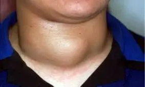 بهترین درمان های موثر برای بیماری گواتر