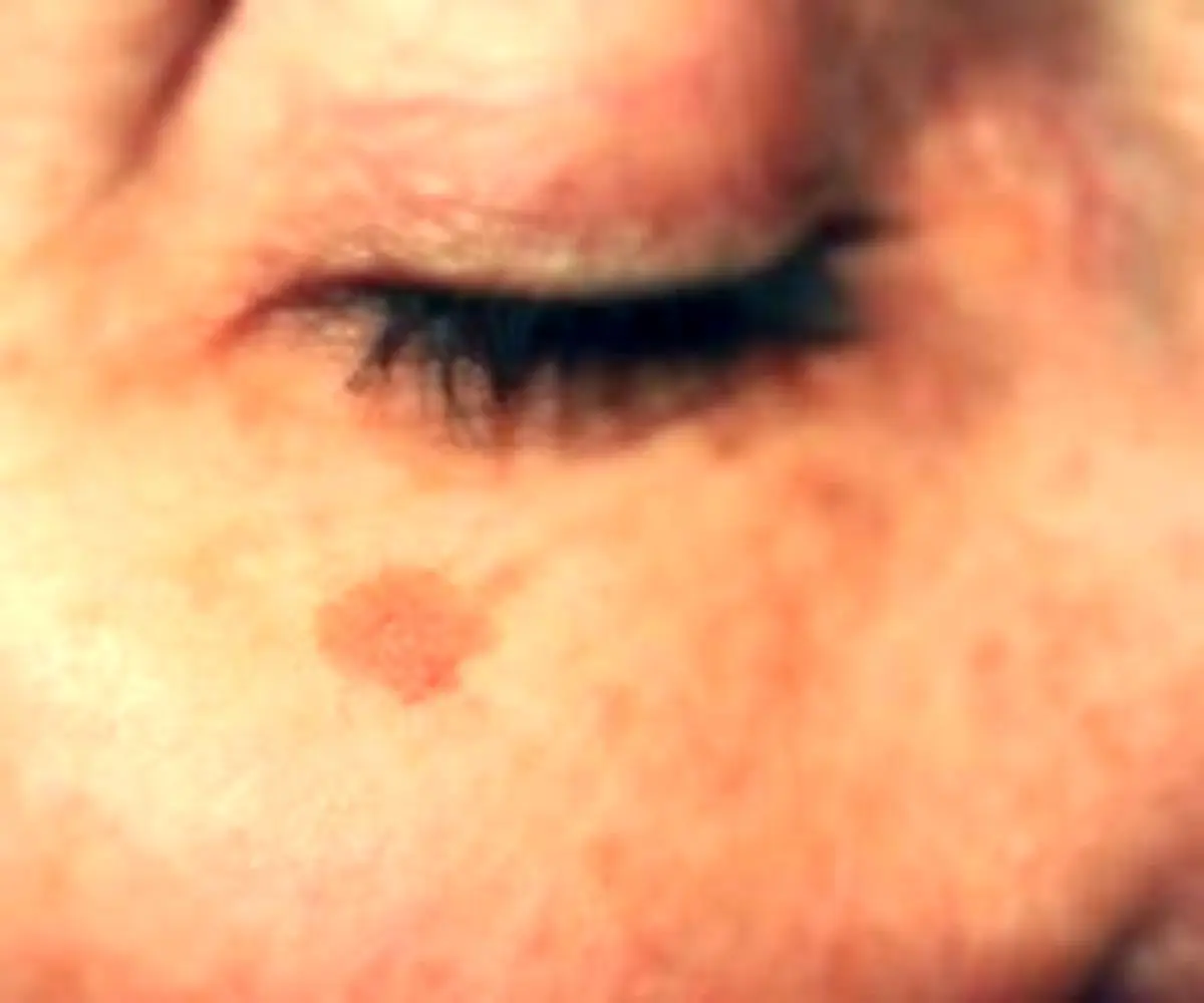 با ماست لکه های کبدی روی صورت را درمان کنید