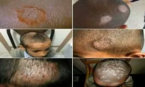 بیماری کچلی دانش آموزان‌ "شمس آباد" ایرانشهر کنترل شده است