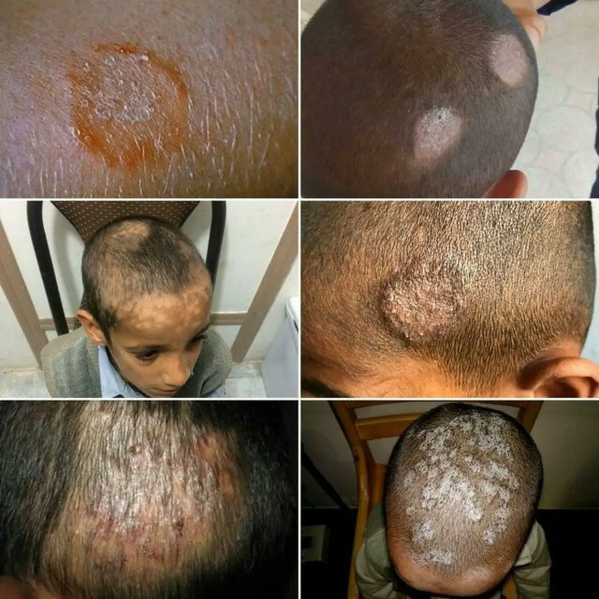 بیماری کچلی دانش آموزان‌ "شمس آباد" ایرانشهر کنترل شده است