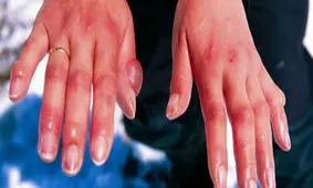 این علائم سرمازدگی را جدی بگیرید