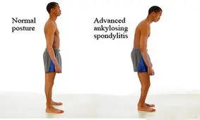 همه چیز درباره اسپونديليت‌ آنكيلوزان‌