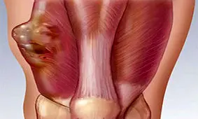 سرطان سارکوم را بشناسید! علائم،علل و درمان سارکوم