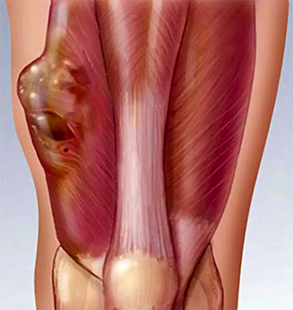 سرطان سارکوم را بشناسید! علائم،علل و درمان سارکوم