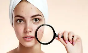 درمان جوش صورت در بارداری با ۶ روش طبیعی