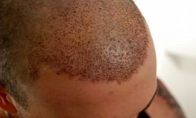 آنچه باید درباره جراحی کاشت مو بدانید