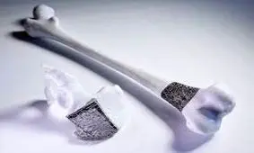 پرینتر سه بعدی به کمک مبتلایان به سرطان استخوان می آید