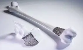 پرینتر سه بعدی به کمک مبتلایان به سرطان استخوان می آید