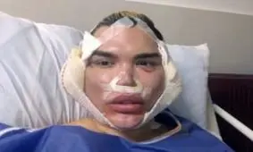 چهره مرد عروسکی پس از 5 جراحی زیبایی در ایران + عکس