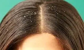 هر آنچه که باید درباره شوره سر بدانید