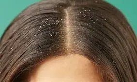 هر آنچه که باید درباره شوره سر بدانید