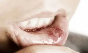 چه نوع زخمی از نشانه های سرطان دهان است؟