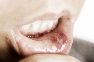 چه نوع زخمی از نشانه های سرطان دهان است؟