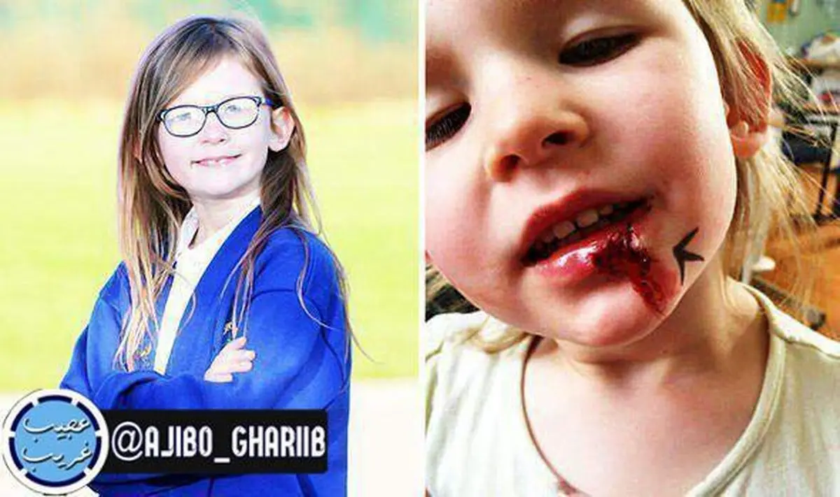 تنها انسان شناخته شده با کمبود کروموزوم شیش