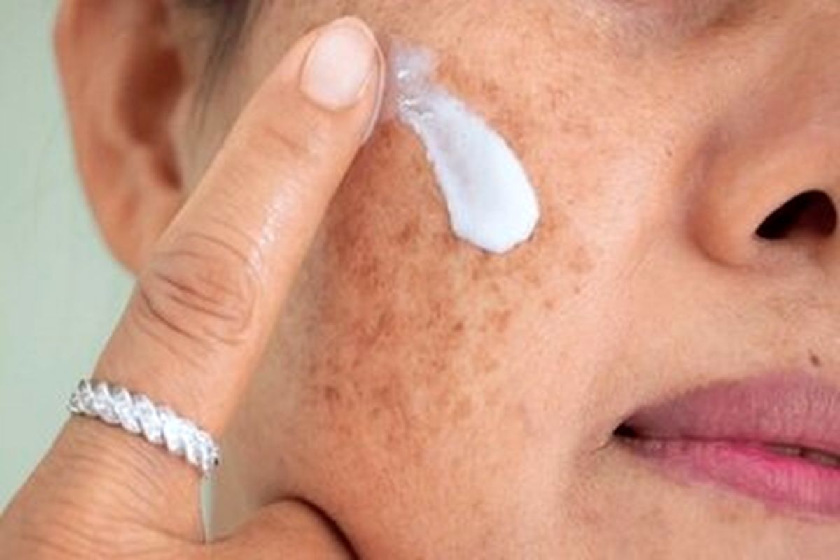 لکههای پوستی را چگونه درمان کنیم؟