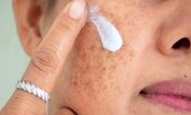 لکه‌های پوستی را چگونه درمان کنیم؟