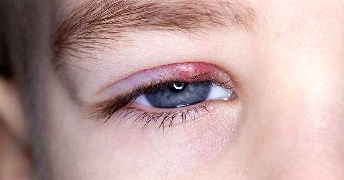 چگونه گل مژه را از بین ببریم؟