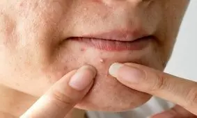 ترکاندن جوش ها چه بلایی سرمان می آورد؟