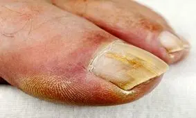 نشانه های قارچ ناخن را بشناسید