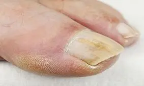 نشانه های قارچ ناخن را بشناسید
