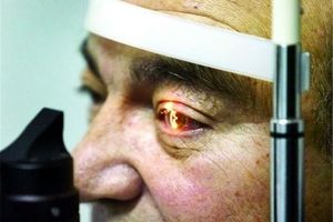 بیماری یوئیت چشم را بشناسید