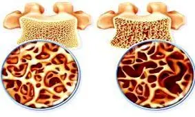 حدود 30 درصد جمعیت ایران به پوکی استخوان مبتلا هستند