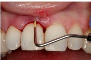 پاک کردن سریع جرم دندان با روش خانگی