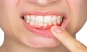 راه خلاصی از ژنژیویت و التهاب لثه