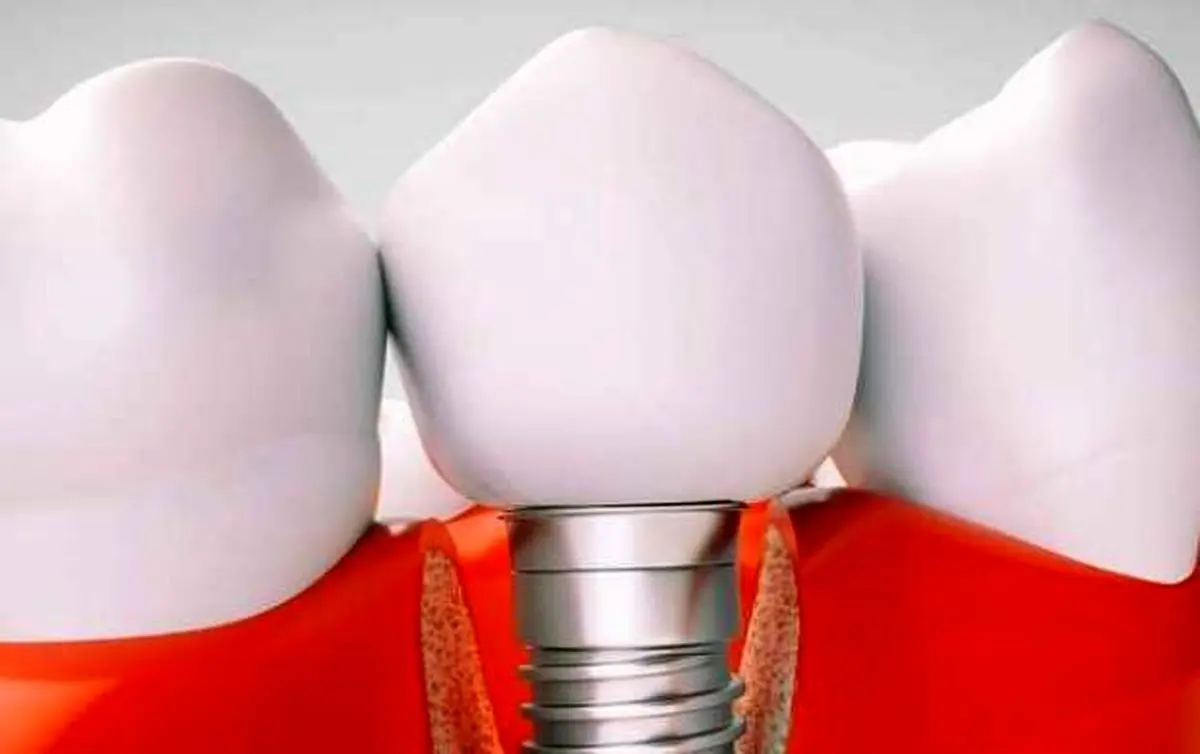 دلیل ایجاد عوارض در ایمپلنت