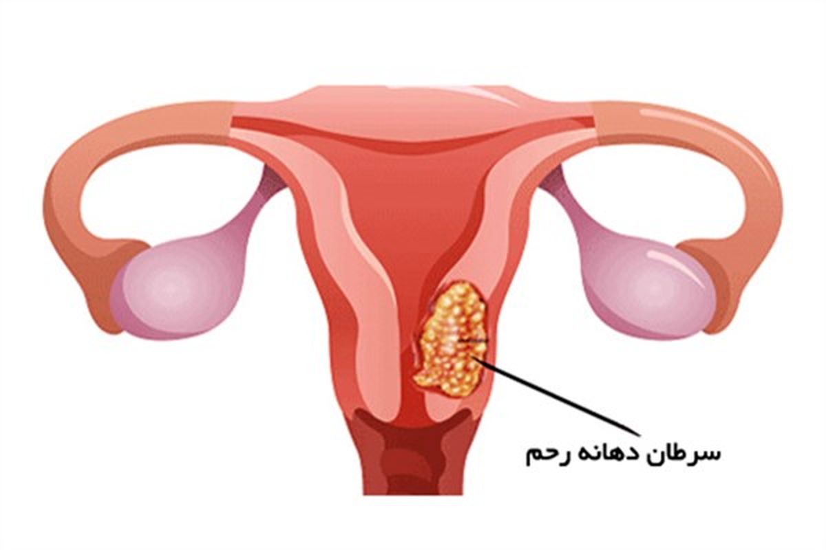 همه چیز درباره سرطان دهانه رحم