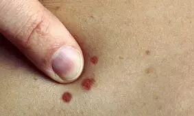 چگونه از سرطان پوست جلوگیری کنید