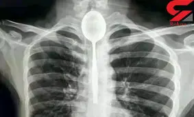 قورت دادن قاشق 20 سانتی سر شرط بندی / قاشق یکسال در گلویش بود + عکس