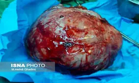 خارج شدن تومور ۲ کیلویی از ریه زن باردار در بندرعباس