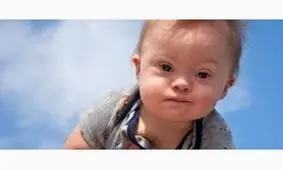 50درصد کودکان با به سندروم داون مشکلات قلبی و نیاز به جراحی دارند