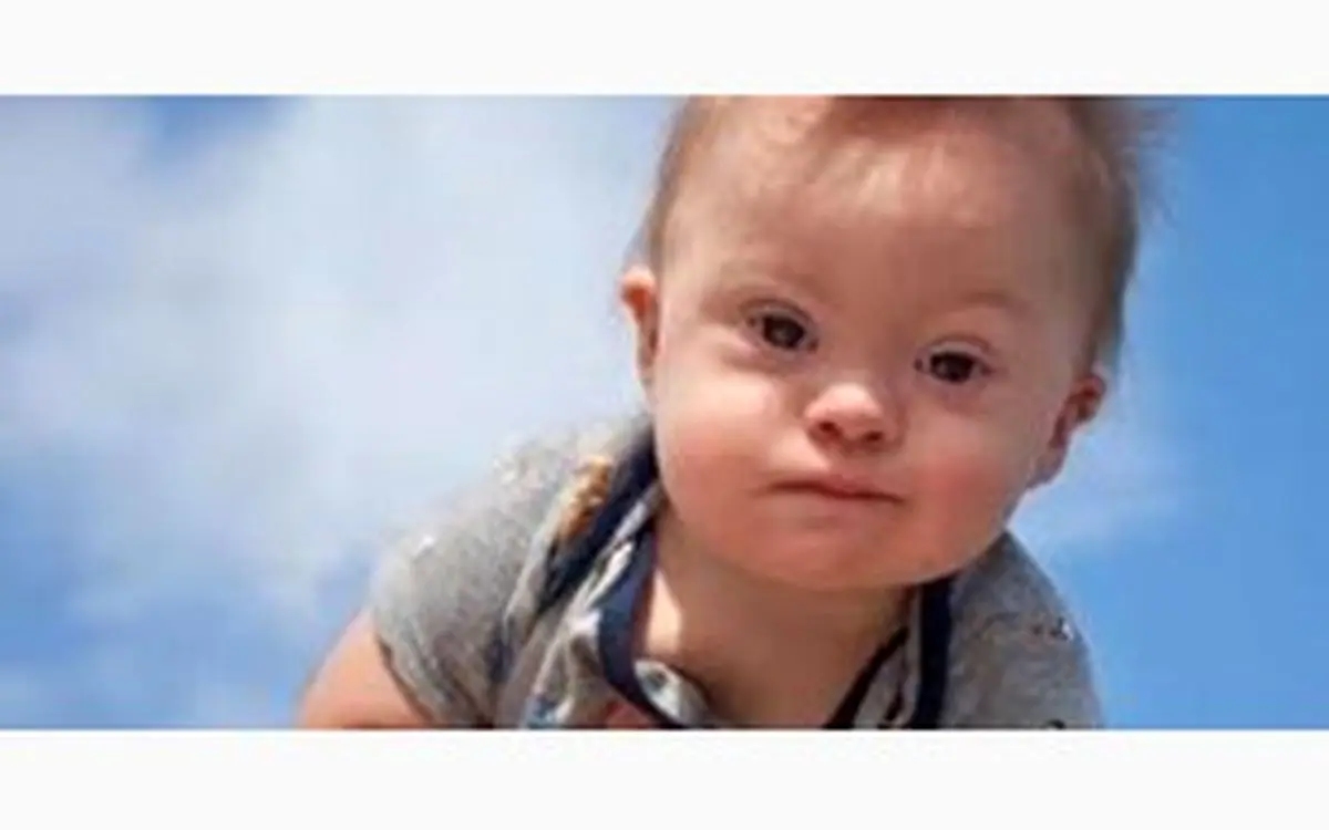 50درصد کودکان با به سندروم داون مشکلات قلبی و نیاز به جراحی دارند