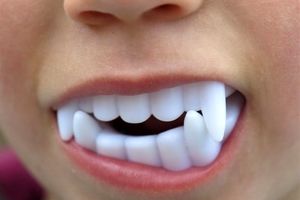 دندان شیشه‌ای دراکولا، کودک ۵ ساله را روانه بیمارستان کرد
