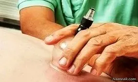 حجامت برای چه بیماری‌هایی مفید است؟