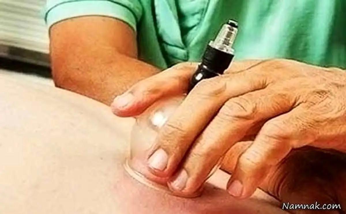 حجامت برای چه بیماری‌هایی مفید است؟