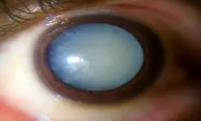 از کجا بفهمیم آب مروارید داریم؟ + علائم و انواع آب مروارید چشم