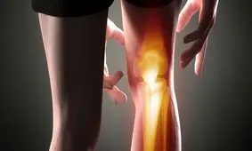 ۳۰ درصد ایرانیان گرفتار آرتروز