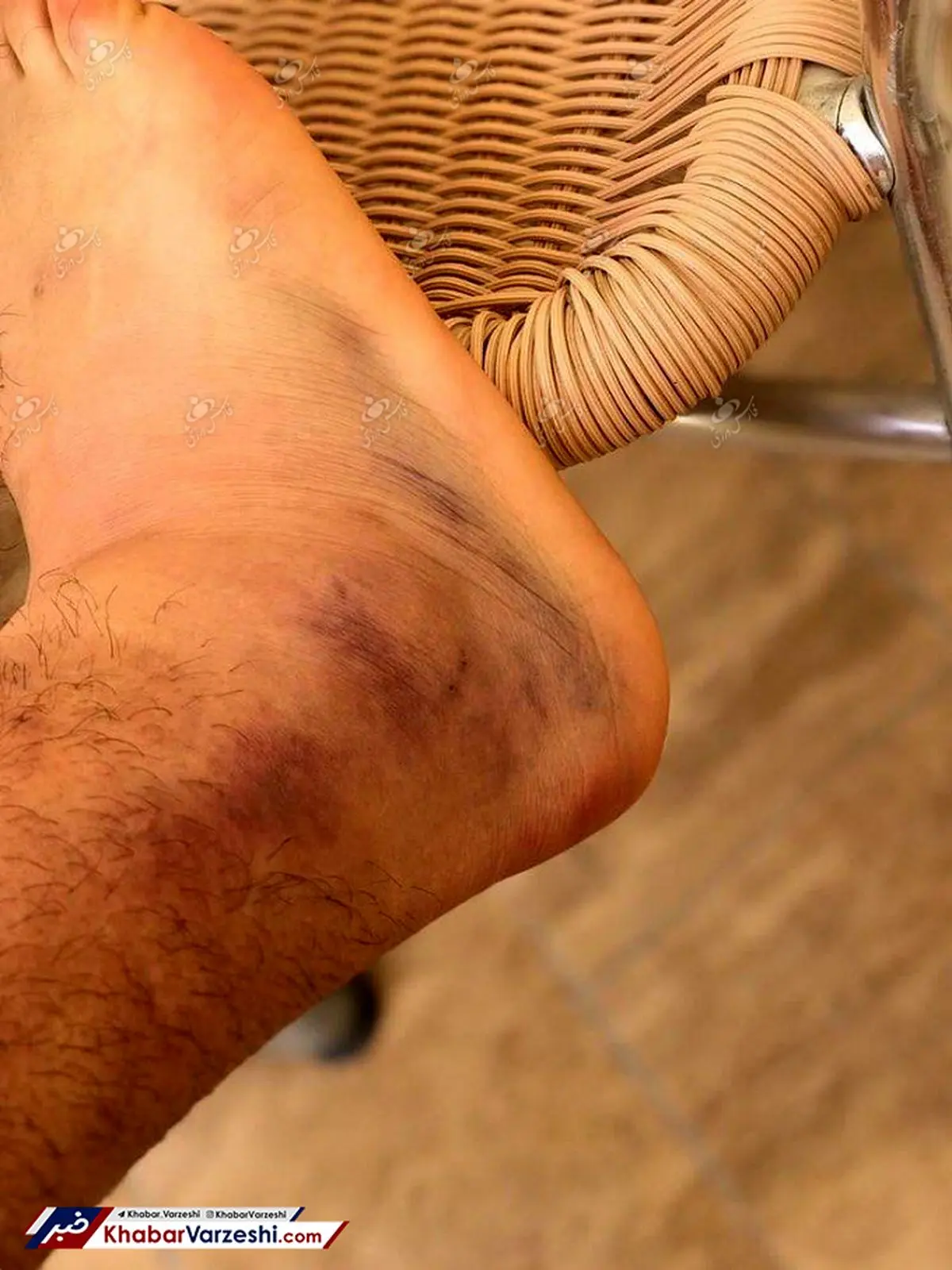 تصویر/ وضعیت بد پای عالیشاه